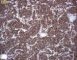 CD20 positivity in a large cell lymphoma