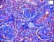 WT-associated diffuse mesangial sclerosis