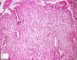 Duodenal localization of an infantile myofibromatosis