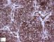 Ewing sarcoma: CD99 positivity