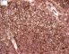 Ewing sarcoma: CD99 positivity