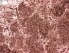 Ewing sarcoma: CD99 positivity