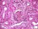 WT1-associated FSGS