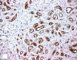 GLUT1 in infantile hemangioma