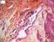 Digestive GVH