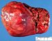 Hepatoblastoma