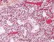 Hyaline membrane disease