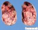 Ovarian immature teratoma