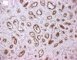 GLUT1 in infantile hemangioma