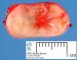 Intradural extramedullary schwannoma