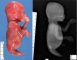 Caudal regression syndrome with sirenomelia unipus