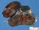 Polysplenia in malformative association