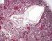 Fetal oligocystic kidneys of unknow cause (case 11389)