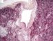 Fetal oligocystic kidneys of unknow cause (case 11389)
