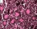 Poorly differentiated neuroblastoma (case 13512)