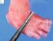 Foot syndactyly 1-2 (fetus, 24 weeks)