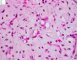 Myxoid liposarcoma