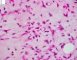 Myxoid liposarcoma