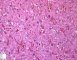 Focal adrenal cytomegaly in 47,XXX fetus ith ring chromosome (...)
