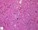 Focal adrenal cytomegaly in 47,XXX fetus ith ring chromosome (...)