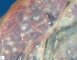 Amnion nodosum