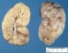 ARPKD kidney in a neonate (1 month)
