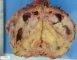 Caliceal urothelial carcinoma with pyonephrosis