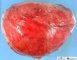 Cystic malignant rhabdoid tumor