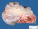 Osteochondroma