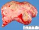 Intestinal loop aggregate in gastroschisis