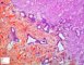 Portal and septal fibrosis in ductal plate malformation (congenital hepatic (...)