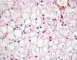 Hepatic glycogenosis (HPS)