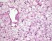 Hepatic glycogenosis (PAS + diastase)