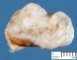 Mediastinal primitive foregut cyst