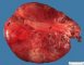 Mesenteric cystic lymphangioma