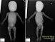 Femoral bowing in osteogenesis imperfecta (21 weeks) with normal (...)