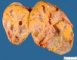 Ovarian thecoma