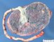 Long insertion of the umbilical cord