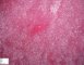 invasive pulmonary aspergillosis