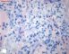 Cutaneous leishmaniasis