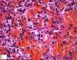 Cutaneous leishmaniasis