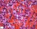 Cutaneous leishmaniasis