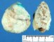 Lingual lymphangioma