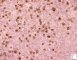 CD30 in mixed cellularity Hodgkin lymphoma