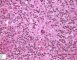 mixed cellularity Hodgkin lymphoma
