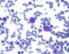 Parvovirus B19 cytopathogenic effect in bone marrow