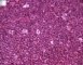 Precursor B lymphoblastic lymphoma