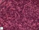 Precursor B lymphoblastic lymphoma