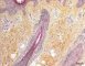 Accessory tragus