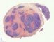 Nodular sclerosing Hodgkin lymphoma